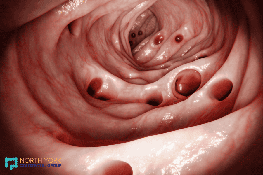An endoscopic view of the inside of a colon affected by diverticulosis, showing multiple small outpouchings (diverticula) in the intestinal lining.