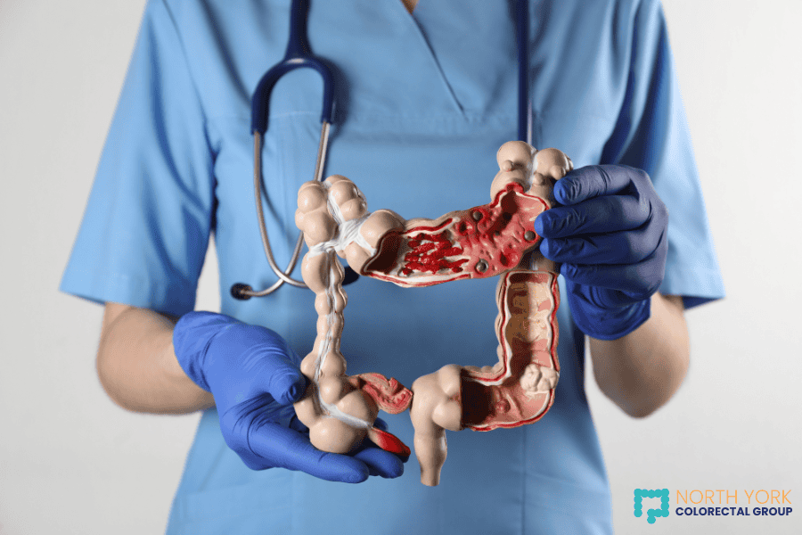 A healthcare professional in blue scrubs and gloves holds a cross-sectional model of the human colon, showing the interior anatomy and possible areas affected by colon cancer.