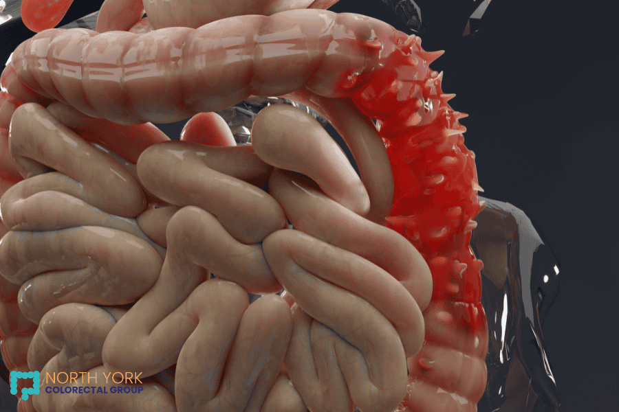 A 3D medical illustration showing a segment of the intestines with diverticula, highlighting the condition known as diverticulitis with inflamed and swollen pockets.